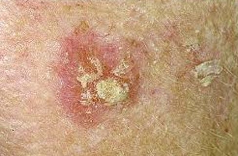 actinic keratosis