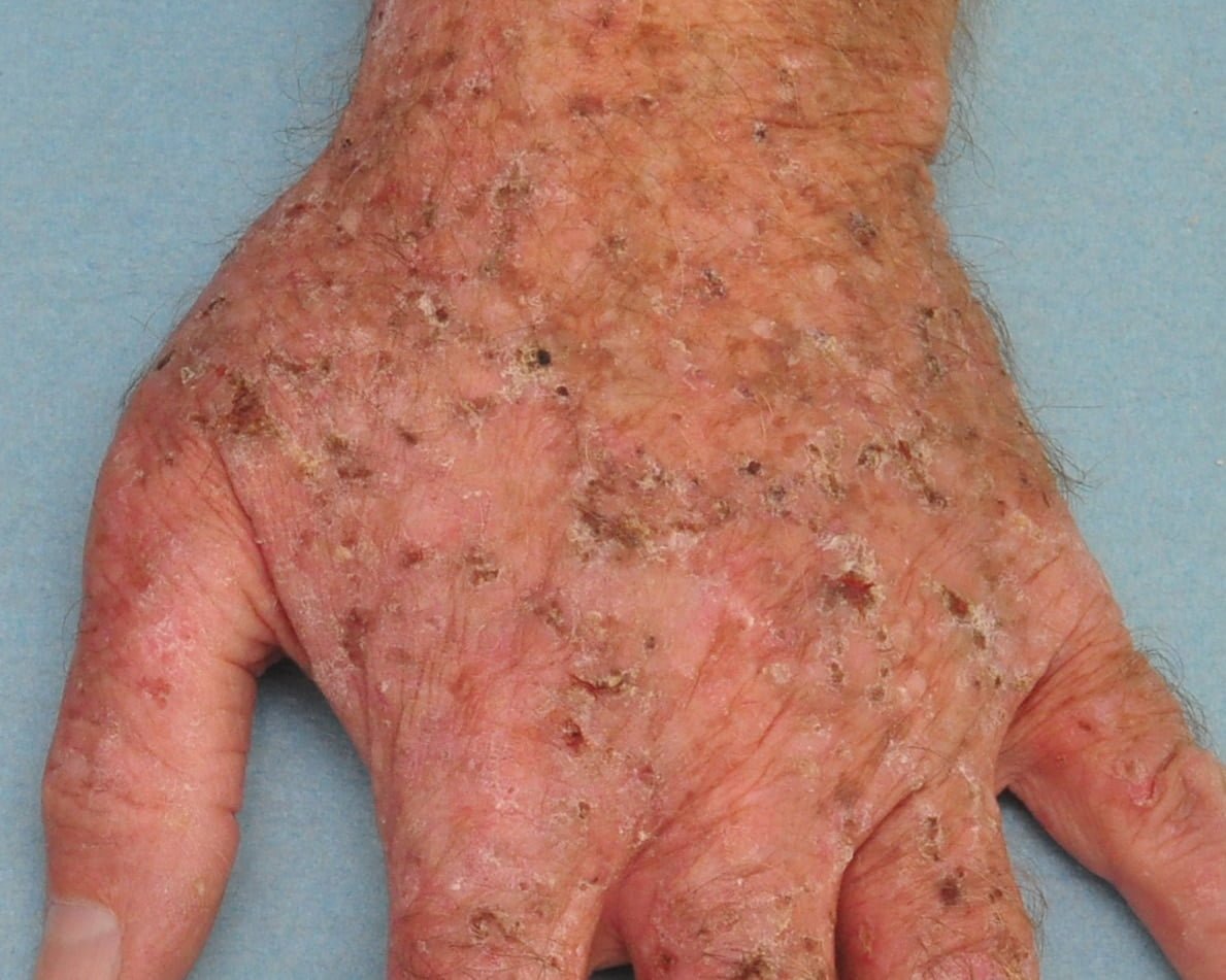 actinic keratosis