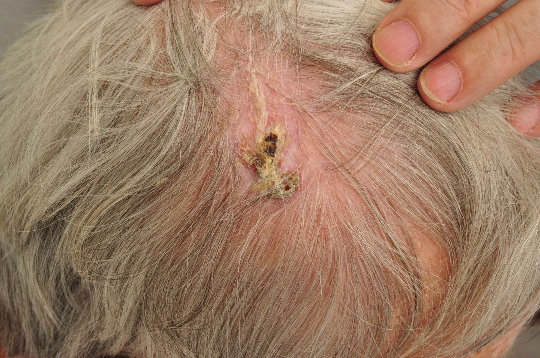 actinic keratosis