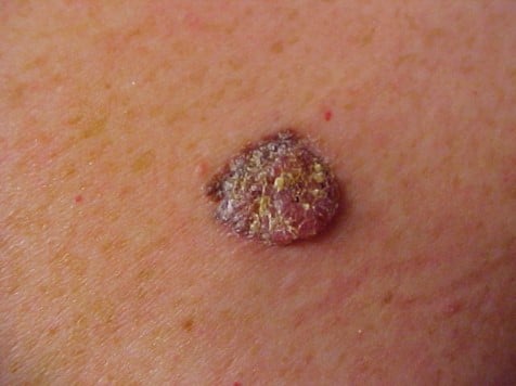 Billede af malignt melanom, også kaldet modermærkekræft