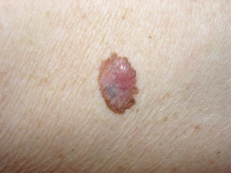 Billede af malignt melanom, også kaldet modermærkekræft