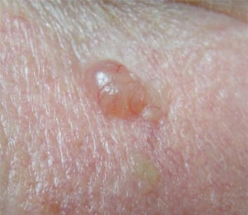 basal cell carcinoma