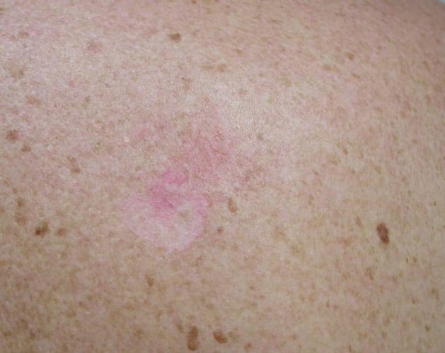 basal cell carcinoma