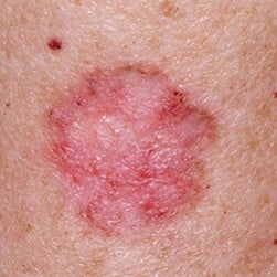 basal cell carcinoma