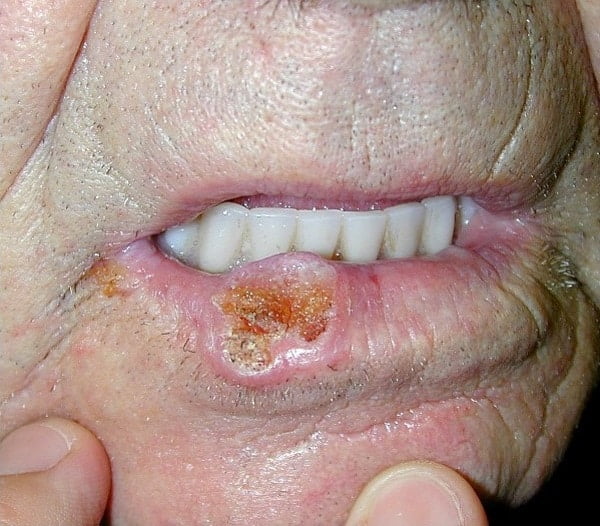 Squamous cell cancer