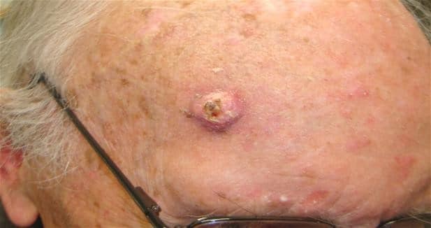 Squamous cell cancer