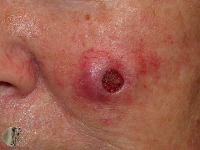 Squamous cell cancer