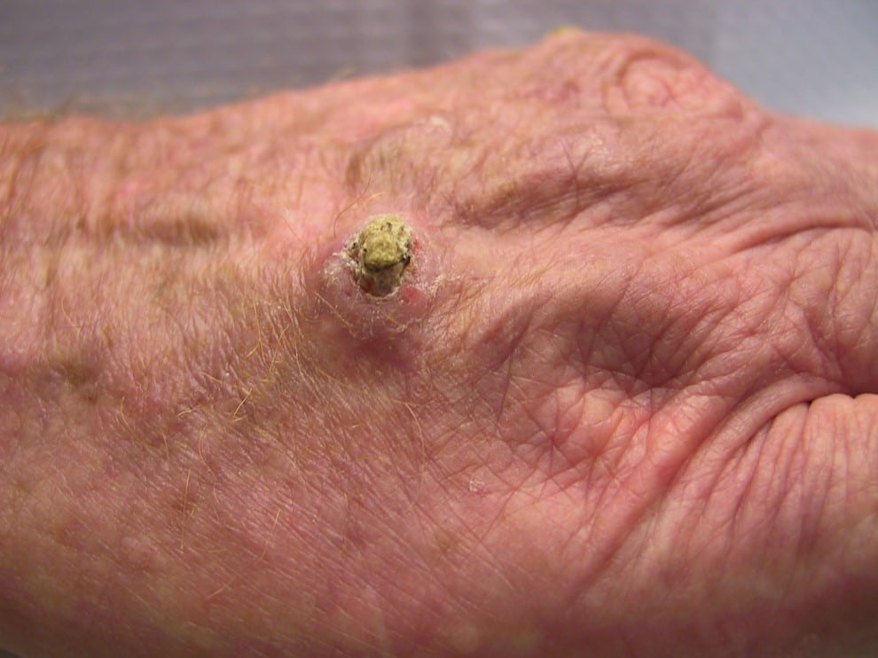 Squamous cell cancer